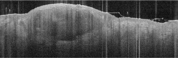 Optical Coherence Tomography (OCT)